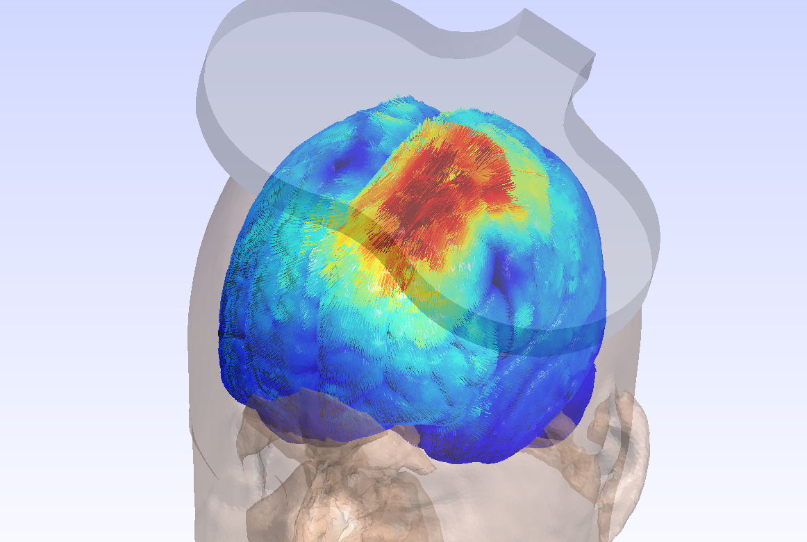Estimulación cerebral no invasiva